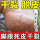 腳脫皮去真菌皮膚干裂脫皮腳后跟干裂專用藥真菌感染干裂脫皮腳裂膏腳后跟干裂開裂角化型腳氣手足腳底華佗膏 1乳膏+1噴霧【搭配用 雙效治 效果更加】