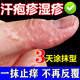 汗皰疹藥膏起水泡癢汗皰疹止癢去真菌感染皮膚瘙癢皮炎濕疹止癢手起小水泡癢脫皮干復(fù)方倍氯米松樟腦乳膏 1盒【手上起小水泡手指真菌感染】
