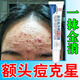 南京同仁堂祛痘膏去痘印額頭上長(cháng)痘痘閉口修復痘坑神器除青春痘學(xué)生男女專(zhuān)用 單盒裝【體驗裝】南京同仁堂
