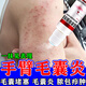 克林霉素甲硝唑搽劑去除手臂毛囊炎長痘痘胳膊上的雞皮小疙瘩有黑點紅點堵塞疏通皮膚專用藥 1盒【標(biāo)準(zhǔn)裝】