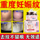 其他其她妊娠紋修復霜產(chǎn)后去除100%消除緊致肚皮松弛專(zhuān)用淡化祛生長(cháng)紋疤膏 一盒【體驗裝】 妊辰紋霜