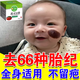 圣鑫堂胎記去除膏去胎記訷器去除黑色素咖啡斑臉部祛胎記神器遺傳紅胎記 一盒裝【胎記專用祛除膏】