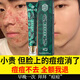 南京同仁堂祛痘膏去痘痘和痘印痘坑修復男女士改善粉刺閉口30g七夕