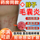 優(yōu)立特【醫用】脖子毛囊炎長(cháng)痘痘專(zhuān)用噴劑膏痤瘡膏疙瘩膿皰瘡藥監備案HB 【單盒裝】脖子毛囊凈噴霧抑菌噴劑