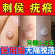 猴子去除藥膏去猴子專(zhuān)用特治療效藥刺猴專(zhuān)用的藥刺猴子尋常疣刺瘊子去除特專(zhuān)用效藥疣瘊水楊酸軟膏皮膚用藥 1盒【肉粒刺猴去除專(zhuān)用藥音】去猴子脖子小肉粒