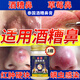克頓默奧酒糟鼻草莓鼻紅腫玫瑰痤瘡紅鼻子專用去粉刺黑頭紅血絲螨蟲修護(hù)軟 三盒周期裝（中度型） 搭紅鼻子酒糟鼻頭紅腫消炎產(chǎn)品用