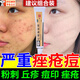 異維a酸+紅霉素凝膠乳膏去黑頭治療痤瘡臉上長(cháng)痘痘的藥痤瘡膏膿皰瘡小顆粒痘痘藥膏痤瘡可選紅霉素軟膏gb 1盒裝【臉上長(cháng)痘 粉刺】