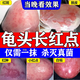 紅霉素軟膏私處止癢男性龜頭炎專用藥真菌感染紅點瘙癢霉菌性包皮炎龜頭紅點紅斑不痛不癢專用藥皮膚用藥 1盒【龜頭紅點瘙癢霉菌性龜頭炎】