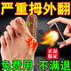 拇外翻矯正貼膏腳趾變形大拇矯炎疼拇囊炎重疊大腳骨突出外翻畸形 一盒