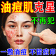 喬記醫用祛痘消炎面膜痤瘡專(zhuān)用膏藥青少年學(xué)生去青春痘粉刺硬疙瘩痘印 一盒面膜【發(fā)貨特效快】 祛痘消炎痤瘡專(zhuān)用面膜淡化痘印修復皮膚屏障