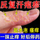汗皰疹藥膏皮膚瘙癢皮炎濕疹真菌感染汗皰疹濕疹止癢手起水泡癢脫皮干止癢抑菌復(fù)方倍氯米松樟腦乳膏 1盒【手上起小水泡手指真菌感染】