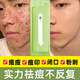 鮮一祛痘精華液護膚品去痘痘和痘印377煙酰胺凝膠美白精華淡斑青少年 2片裝-祛痘凝膠小樣