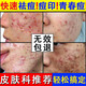 YYTISS祛痘藥膏淡化痘印消除坑炎痤瘡專用青少年去痘痘和痘印青春痘學(xué)生
