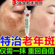 維a酸乳膏去老年斑專用藥祛斑專用藥老年斑專用藥一夜i消去斑去黑色素的藥臉部手背皮膚用藥 非處方藥 1盒【點斑祛斑專用藥】