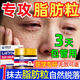 日本脂肪粒去除神器眼部專用去脂肪粒眼霜去脂肪粒藥膏汗管瘤克星 【單盒裝 無買贈】