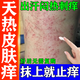 熱癢止癢膏抑菌皮膚瘙癢身體癢止癢皮膚瘙癢皮炎濕疹真菌感染止癢藥膏天熱疙瘩復方倍氯米松樟腦乳膏 1盒【身上癢起紅疙瘩長(cháng)紅點(diǎn)】早用早舒服