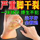 日本化藥腳裂膏腳后跟干裂開(kāi)裂真菌感染干燥脫皮真菌去老繭護腳霜手足皸裂 單盒裝【50ml】