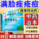 清熱暗瘡丸祛痘痘粉刺痘印醫用痤瘡中藥去青春痘紅腫硬疙瘩痘印消炎膿皰去痘印青少年痤瘡專(zhuān)用藥【視覺(jué)特效】 3盒【中藥治本 內調祛痘】療程裝