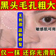 阿達帕林凝膠醫用收縮毛孔粗大修復細致祛痘印修復淡化痘印痘坑修復藥膏祛痘消炎痤瘡專(zhuān)科皮膚用藥祛痘印黑頭 1盒【治療痤瘡建議三盒裝】