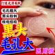 阿達(dá)帕林凝膠醫(yī)用祛痘消炎痤瘡專(zhuān)用治療痘痘痤瘡淡化痘印痘坑改善毛孔粗大進(jìn)口祛痘藥 1盒福利爆款 鑫燁阿達(dá)帕林凝膠10g 【閉口粉刺】