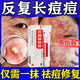 祛痘藥膏祛痘消炎痤瘡專(zhuān)用去痘痘和痘印痘痘特正效藥醫用臉上長(cháng)痘痘專(zhuān)用藥痘坑修學(xué)生青春痘祛痘膏紅霉素軟膏 1盒【痤瘡專(zhuān)用藥】