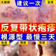 阿昔洛韋乳膏凝膠軟 帶狀皰疹后遺癥神經(jīng)痛用藥斷貨根 蛇盤(pán)瘡生殖器皰疹也可用抗病毒軟膏【視覺(jué)特效】 2盒【輕度癥狀適用】