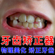 巴貝奇  BABBAGE牙齒矯正器深覆合地包天牽引神器嘴凸磨牙隱形透明牙套夜間防磨H 兒童款低配（第一階段）偏軟