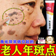 維a酸乳膏角化異常引起老人年斑臉部手背祛斑點(diǎn)斑專用OTC藥霜水去老人年斑專用OTC藥一皮夜消 1盒