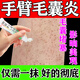 手臂毛囊炎專(zhuān)用特治療效藥正品毛囊炎藥膏手臂胳膊上的小疙瘩雞皮膚毛囊堵塞皮膚用藥 非處方藥莫匹羅星軟膏 1盒【手臂毛囊炎專(zhuān)用】