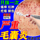 毛囊炎藥膏馬拉色菌毛囊炎 毛囊炎藥專(zhuān)用OTC藥后背雞皮疙瘩膿皰瘡毛囊炎背部皮膚瘙癢膿包紅腫 阿達帕林凝膠 1盒裝【毛囊炎專(zhuān)用】推薦多盒裝