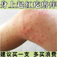 身上皮膚癢秋冬季后背手臂大腿干癢起紅疙瘩長(cháng)小紅點(diǎn)抑菌止癢軟膏 一盒裝