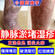 靜脈曲張引起皮膚小腿瘙癢靜脈炎淤積性皮炎濕疹發(fā)黑潰爛止癢藥膏 醋酸曲安奈德益康唑乳膏 2盒 【皮膚瘙癢 越撓越癢】 靜脈曲張引起腿癢潰爛感染外用止癢藥