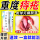 痔瘡膏去肉球內外混合痔瘡專(zhuān)用藥痔瘡藥去肉球出血止癢肛門(mén)瘙癢痣痔藥消腫醫用凝膠熊膽痔靈膏正品 1盒【女性痔瘡治療 消痔】