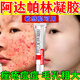 阿達帕林凝膠改善毛孔粗大去看黑頭醫(yī)用祛的痘消炎痤瘡硬疙瘩專用藥痘痘粉刺痘印治療粉刺膿包（視覺特效） 三盒裝【祛痘消炎 痤瘡膿包滿臉痘痘】熱賣款