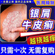 治牛皮癬銀屑病專(zhuān)用藥頑固牛皮癬銀屑病真菌止癢抑菌皮膚藥膏皮膚瘙癢身體癢華佗膏皮膚用藥【視覺(jué)特效】 1盒裝【推薦組合裝迅速緩解牛皮癬癥】