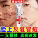 阿達帕林凝膠改得善毛孔粗大醫用祛的痘消炎痤瘡硬疙瘩專(zhuān)用藥痘痘粉刺痘印治療粉刺膿包皮膚用藥 1盒【臉上長(cháng)痘】級 祛痘藥膏