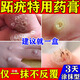 跖疣專(zhuān)用藥水楊酸軟膏去疣軟化角質(zhì)醫用去疣體特雞眼效藥跖疣腳底趾疣去根專(zhuān)用特貼劑效藥hpv腳底老繭硬皮 1盒【治療跖疣專(zhuān)用藥膏】溶解角質(zhì) 無(wú)痛脫落