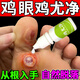 藥健百瑞雞眼膏 去·根肉刺藥i膏無(wú)痛·脫落雞眼貼去·根去肉刺刺猴無(wú)痛 三盒【多年雞眼】