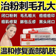 阿達(dá)帕林凝膠醫(yī)用收縮毛孔粗大修復(fù)細(xì)致祛痘印修復(fù)淡化痘印痘坑修復(fù)藥膏祛痘消炎痤瘡?？破つw用藥祛痘印黑頭 1盒裝【皮膚用藥 非處方藥】
