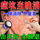 千紹方痘坑修復凹洞痘印淡化消填充再生凝膠生長(cháng)因子祛痘疤黑色素沉淀膏 一盒【多盒使用效果更佳】