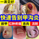 華林堂甲溝炎專用根的治腳趾甲往肉里長去i根消腫止痛去肉芽治嚴(yán)重息肉 100%特效一盒