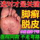 溫醫(yī)師腳癬一次凈真菌感染腳癢腳脫皮臭水泡腳氣爛腳丫糜爛增厚止癢藥膏 1盒【腳癬腳氣脫皮開裂】