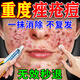 北京同仁堂祛痘消炎痤瘡專(zhuān)用青少年乳膏藥青春痘粉刺硬疙瘩修復消炎去除痘印 特價(jià):拍一發(fā)三盒【僅一天】(發(fā)貨特效快)