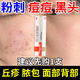 阿達帕林凝膠醫用祛痘消炎痤瘡專(zhuān)用青少年祛痘藥凝膠膏硬疙瘩去痘痘想淡化痘印膿包丘疹紅腫臉上密密麻麻 1盒【建議組合搭配使用效果好】