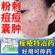 清熱暗瘡丸祛痘痘粉刺痘印醫用痤瘡中藥去青春痘紅腫硬疙瘩痘印消炎膿皰去痘印青少年痤瘡專(zhuān)用藥【視覺(jué)特效】 1盒【醫用祛痘藥】