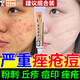 異維a酸+紅霉素凝膠乳膏去黑頭治療痤瘡臉上長(cháng)痘痘的藥痤瘡膏膿皰瘡小顆粒痘痘藥膏痤瘡可選紅霉素軟膏gb 1盒裝【臉上長(cháng)痘 粉刺】
