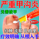 999皮炎平曲安奈德益康唑乳膏甲溝炎外用藥膏專(zhuān)用根本治療腳趾甲往肉里長(cháng)消腫止痛想去肉芽嚴重息肉消炎 1盒裝【指甲長(cháng)肉里 一碰就疼】