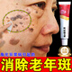 維a酸乳膏祛斑專(zhuān)用藥去老年斑去黑色素去除老年斑特快效藥角化異常引起老人年斑臉部手背祛斑點(diǎn)斑黃褐一夜消 1盒裝【推薦多盒 周期使用】