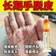 手脫皮嚴重脫皮真菌蛻皮干燥起皮用什么藥手足癬真菌感染藥膏脫皮開(kāi)裂鵝掌風(fēng)皮膚用藥醋酸曲安奈德益康唑乳膏 1盒裝 【手掌脫皮專(zhuān)用藥 手腳脫皮藥膏】