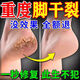 妍綺腳裂專(zhuān)用膏腳后跟干裂干燥開(kāi)裂真菌感染手足脫皮皸裂龜裂藥膏正品 【5盒裝】解決嚴重皴裂